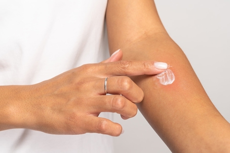 A woman is applying a lotion on her skin